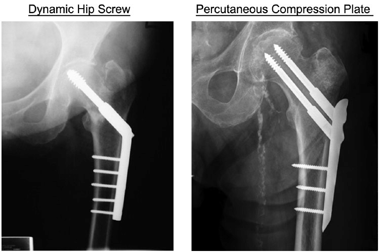 Radiological comparison of dynamic hip screw 16 and percutaneous compression plate 17