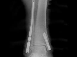 Fibula Nail X- ray