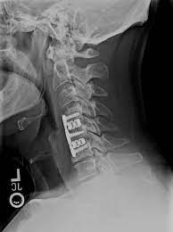 Cervical Cage X-ray