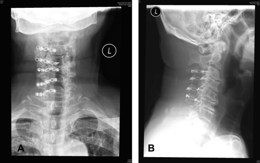 Open Door Plate xray